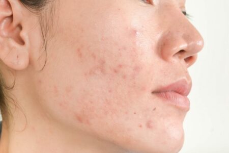 acne scars