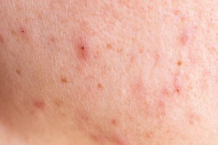 red dots acne