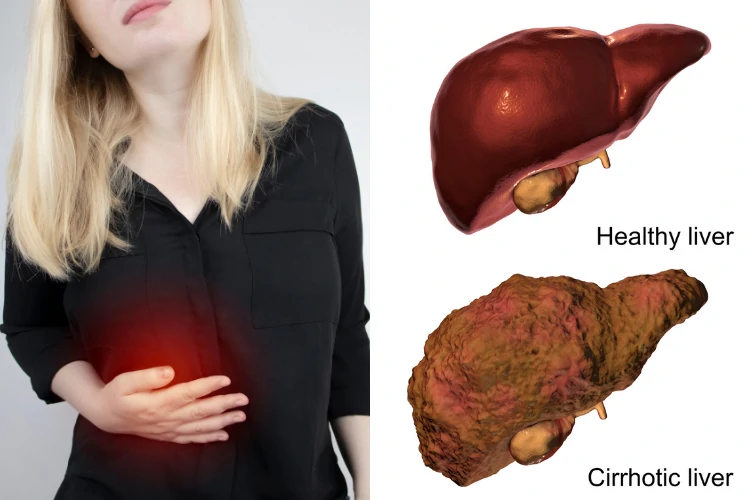 Liver Disease