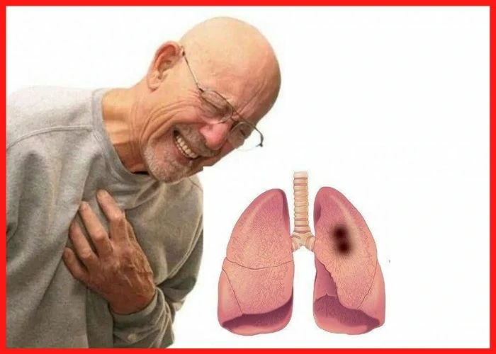 Mesothelioma is, signs of Mesothelioma